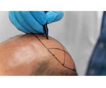 Get Natural Results with FUE Hair Transplant in Greater Kailash