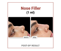 Rhinoplasty Surgical and Non Surgical Treatment in Delhi