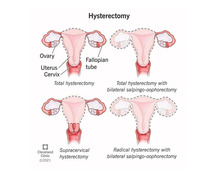 Hysterectomy treatment in Mumbai