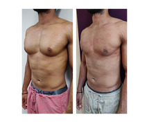 Gynecomastia Surgery in Delhi