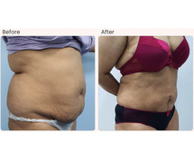 Best Liposuction Treatment in Dubai