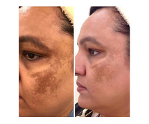 Pigmentation Treatment Cost in Gurgaon