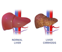 Liver Cirrhosis Treatment