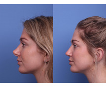 Rhinoplasty Surgery in Delhi