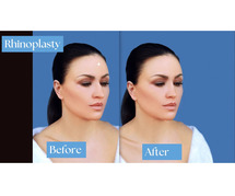 Rhinoplasty Surgery in Delhi