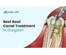 Best Root Canal Treatment in Gurgaon