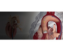 tavr /tavi in India