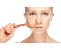 Pigmentation Treatment in Gurgaon