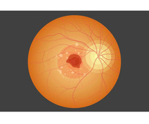 Wet Macular Degeneration Treatment Breakthrough