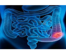 Best Colon Cancer Treatment in Sarjapur Road - Dr. Lohith U