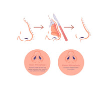 Safe and Effective Rhinoplasty Surgery for Nose Reshaping