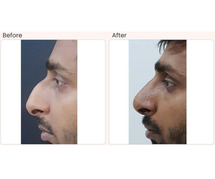 Beat Rhinoplasty Surgery in Delhi - Dr Rajat Gupta