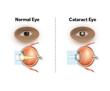 Cataract Eye Surgery in Delhi - Dr Anisha Gupta