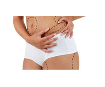 Liposuction Surgery Cost in Delhi - Dr Rajat Gupta