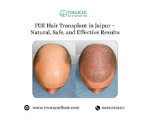 FUE Hair Transplant in Jaipur – Natural, Safe, and Effective Results