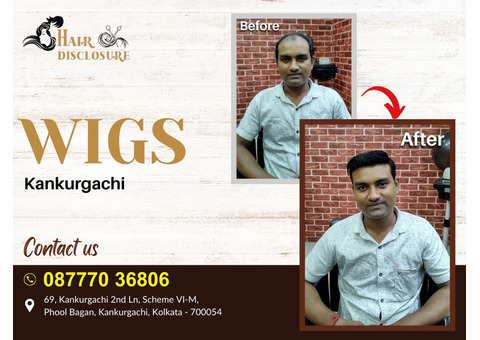 Looking For Best Hair Patch and Hair Wigs Center in Kankurgachi, Kolkata Visit Hair Disclosure