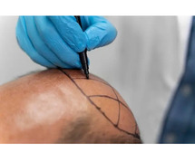 FUE hair transplant in Delhi