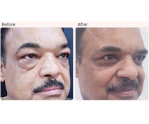 Blepharoplasty Surgery in Delhi - Dr Rajat Gupta