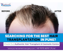 Searching For Affordable Hair Transplant Treatment In Pune - Visit Authentic Hair