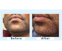 Premature Greying of Beard Treatment in Delhi