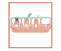 Best Root Canal Treatment in Jaipur