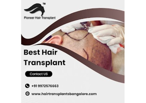 Best Hair Transplant in Bangalore | Hair Transplant Clinic