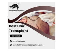 Best Hair Transplant in Bangalore | Hair Transplant Clinic