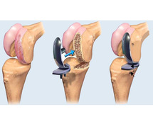 Knee Replacement surgeon in Noida