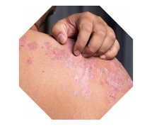 Psoriasis: Natural and Effective Homeopathic Treatment for Long-Term Relief