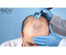 Best Hair Transplant in Bangalore - Anew Cosmetic Clinic