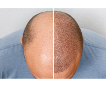 Best Hair Transplant Treatment