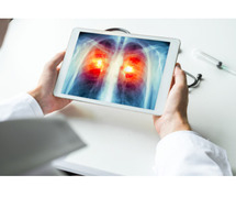 Lung Cancer doctor in Gurgaon