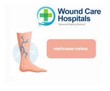 Varicose Veins Treatment in Hyderabad | Kukatpally | KPHB - WCH