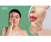 Acne Scar Removal Treatment in Bangalore - Anew Cosmetic Clinic