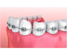 Dental Braces Cost in Gurgaon