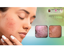 Effective and Deep Acne Scar Treatment in Bangalore - Dermaqure