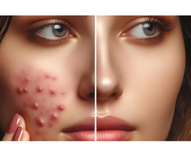 Best Acne Treatment in Delhi at DWC