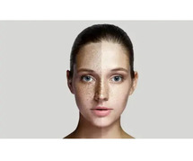 Pigmentation Treatment in Greater Kailash, Delhi | DWC