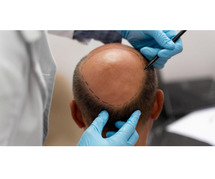 Hair Transplant In Gurgaon