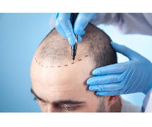 Regain Your Confidence with the Best Hair Transplant Clinic in Jaipur