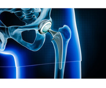 Total Hip Replacement Surgery in Amritsar