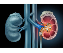 Kidney stone treatment Hospital in Hoshiarpur