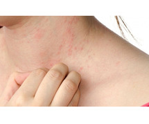 Urticaria treatment in Delhi - Diagnosis, and Treatment