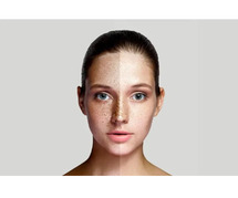 Pigmentation treatment in Delhi