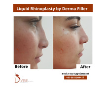 Nose Plastic Surgery Cost in Delhi, - Rhinoplasty