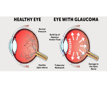 Glaucoma Treatment in Mumbai