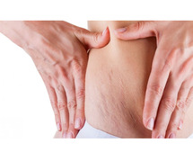 Best stretch marks treatment in Delhi - Solutions for Smooth Skin