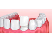 Dental Teeth Straightening / Braces Treatment in Coimbatore