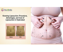 Affordable Liposuction Cost in Hyderabad for a Flawless Look