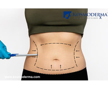 Best Liposuction Surgery in Bangalore - Kosmoderma Skin Clinic